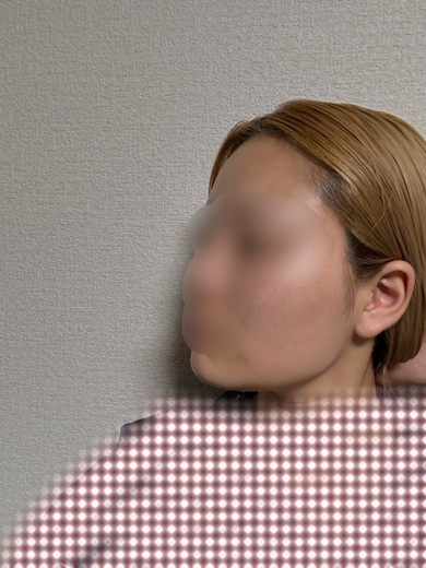 after photo: インモード