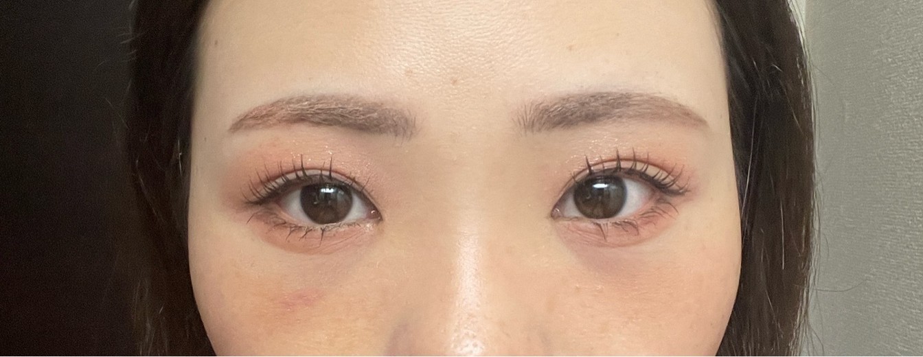 after photo: 脱脂(クマ治療)