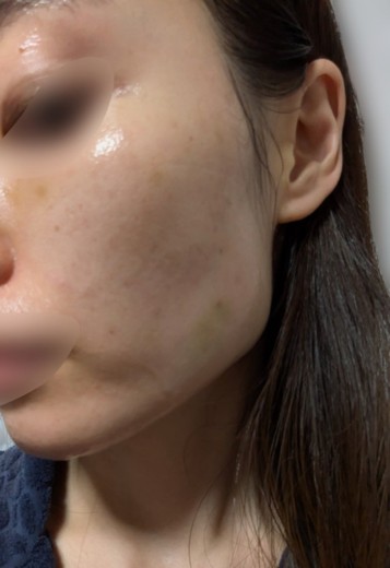 after photo: 脂肪溶解注射(腕), 脂肪溶解注射(太もも)
