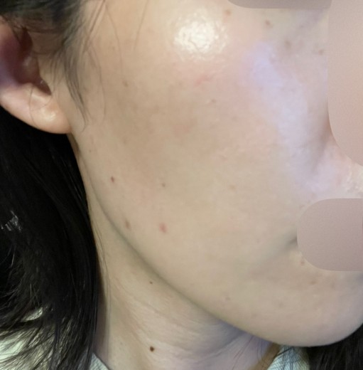 after photo: IPL(光/フォト治療)