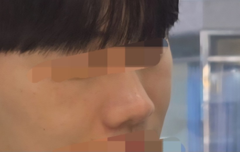 before photo: 비중격만곡증수술