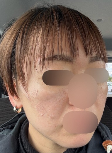 after photo: 糸リフト