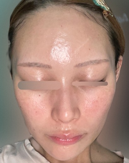 after photo: ジュベルック(Juvelook), サブシジョン(ニキビ跡治療)