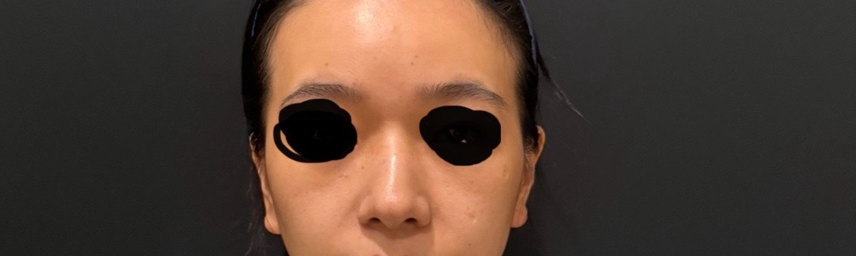 before photo: 비중격만곡증수술