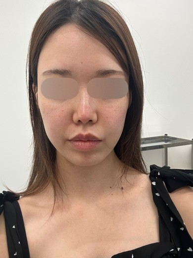 after photo: IPL(光/フォト治療)