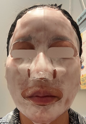 before photo: ダーマペン