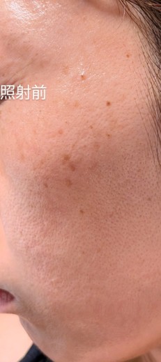 before photo: IPL(光/フォト治療), ルメッカ