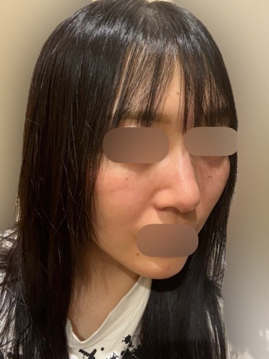 after photo: ピコフラクショナル