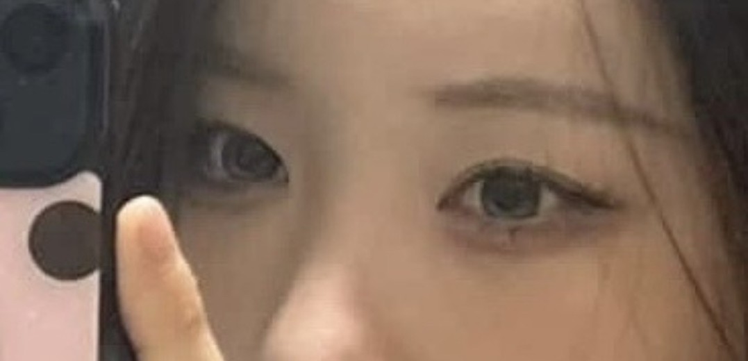 after photo: 눈밑지방이식, 눈밑지방재배치