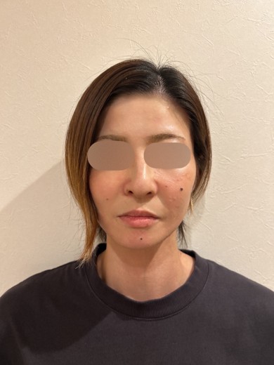 after photo: IPL(光/フォト治療), エレクトロポレーション