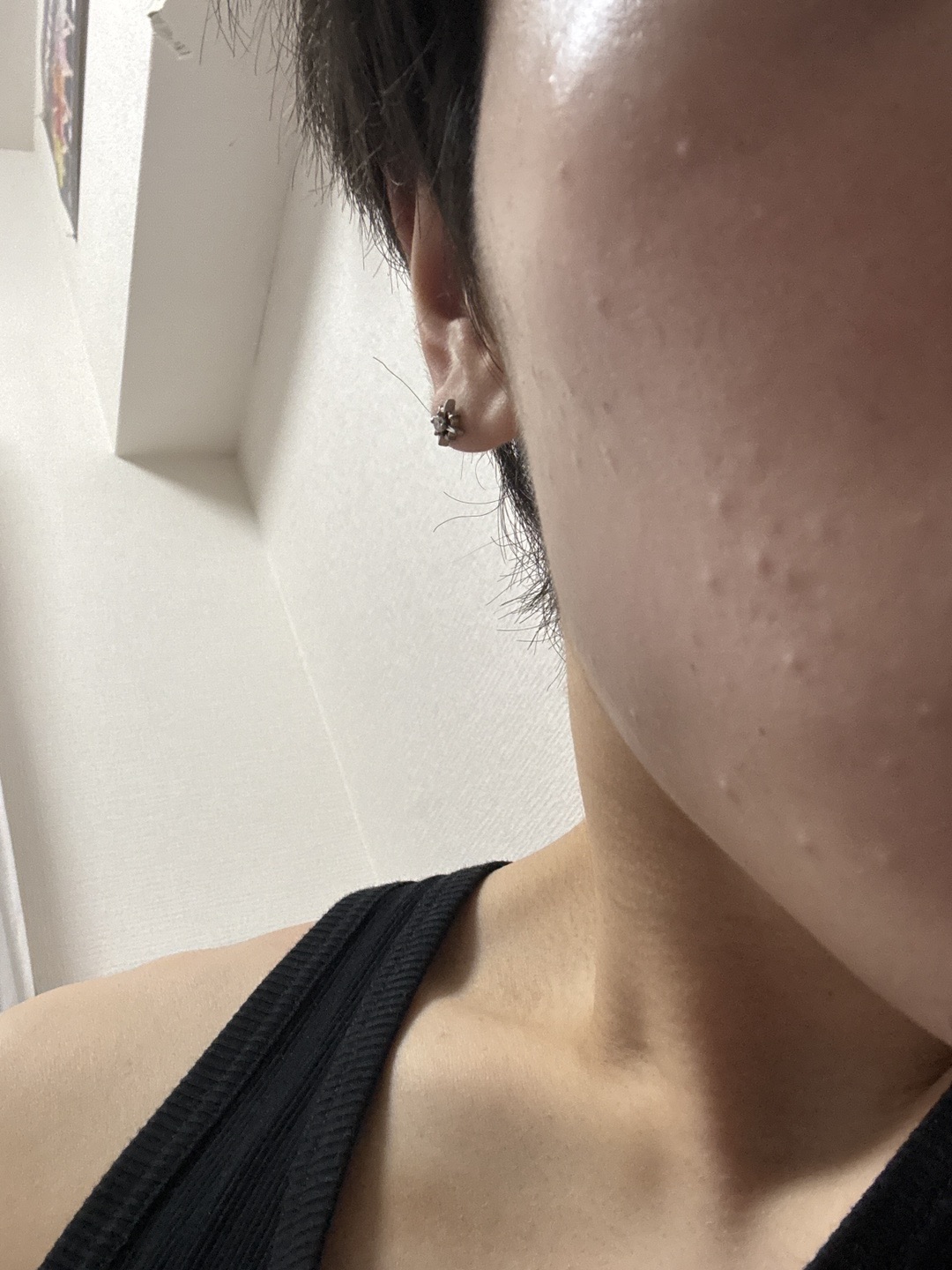 ララピール＋エレクトロポレーション（全顔＋首・1回）【再来OK