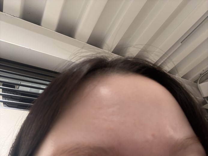 before photo: 잔주름보톡스