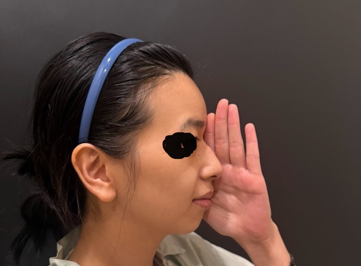 before photo: 비중격만곡증수술