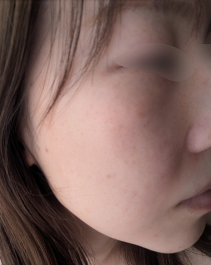 before photo: IPL(光/フォト治療), ピーリング