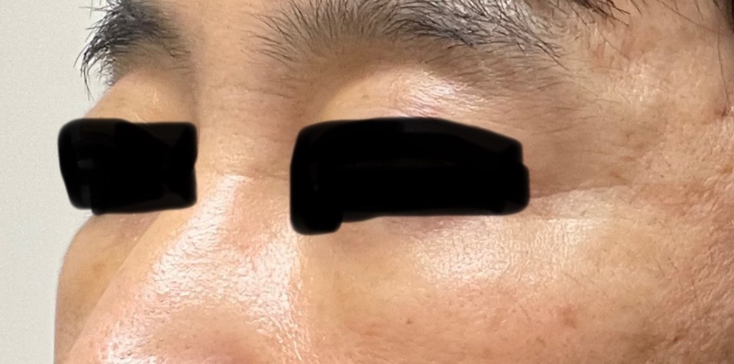 after photo: サーモン注射