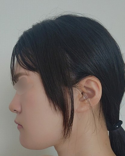 before photo: チタニウムリフト