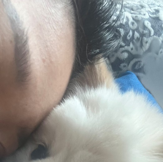 before photo: 이마필러