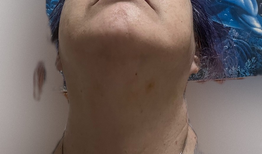after photo: 脂肪溶解注射(顔)