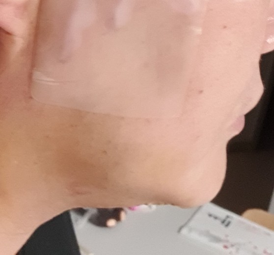 after photo: 이중턱지방흡입, 이중턱근육묶기