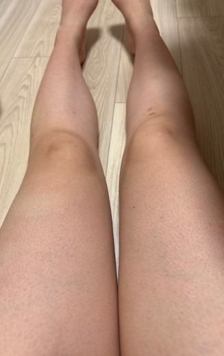 before photo: 高周波脂肪溶解(太もも)