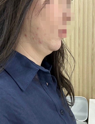 before photo: 이중턱지방흡입, 얼굴지방흡입