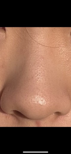 before photo: 콧볼보톡스, 코조각주사