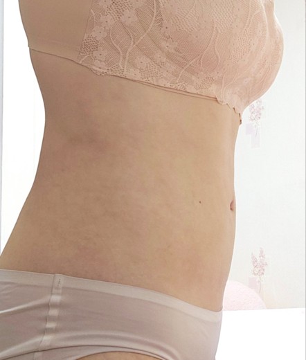 after photo: 러브핸들지방흡입, 복부지방흡입