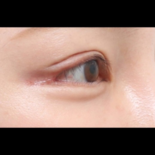 after photo: 밑트임, 뒤트임