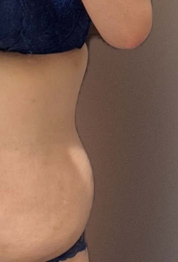 before photo: 脂肪溶解注射(腹部)