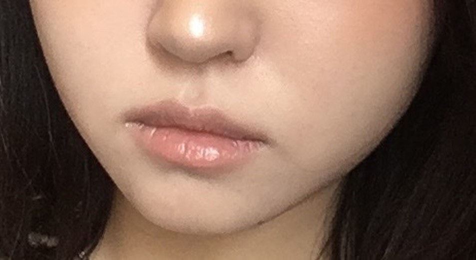 after photo: 윤곽주사, 얼굴지방분해주사