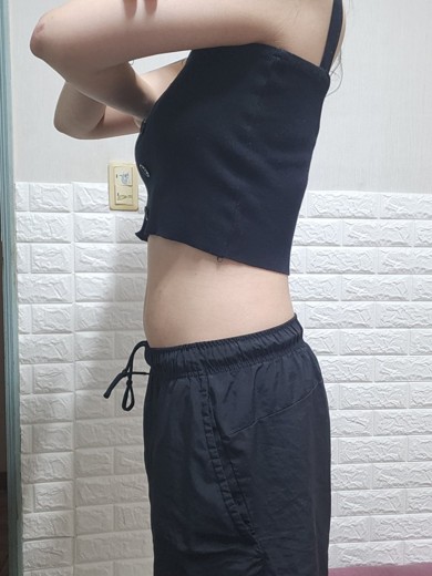 after photo: 복부지방분해주사, 팔지방분해주사