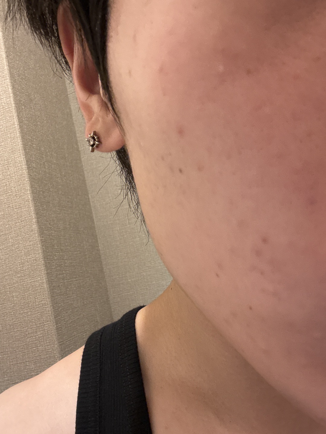 ピーリング　エレクトロポレーション エレクトロポレーション（イオン導入）｜美容皮膚科なら湘南美容