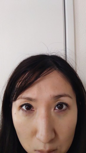 after photo: 脱脂(クマ治療)
