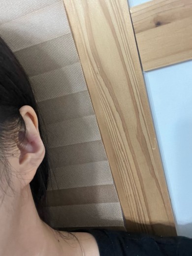 after photo: 캘로이드귀성형