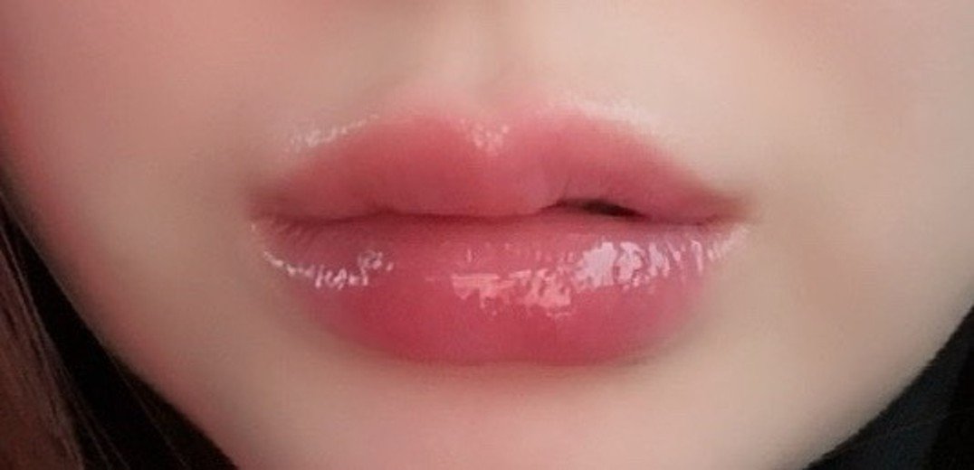 after photo: 입꼬리필러, 입술필러