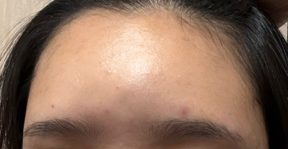 after photo: 이마필러, 관자놀이필러