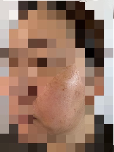 after photo: ピコスポット