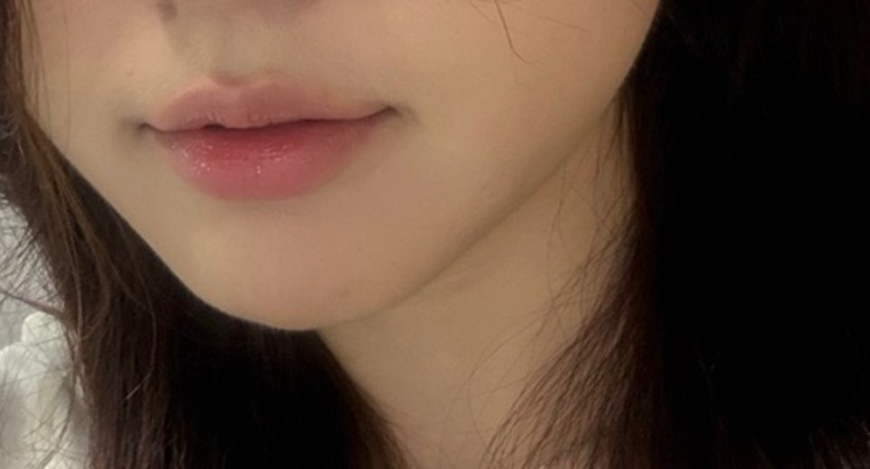 after photo: 윤곽주사, 사각턱보톡스