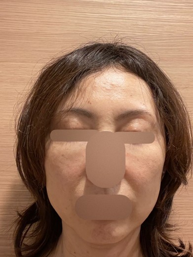 after photo: ハイフ(HIFU)
