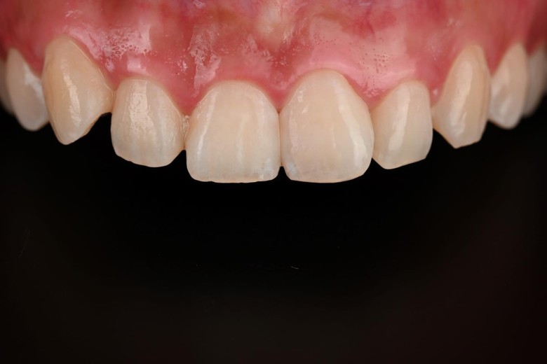 before photo: 라미네이트