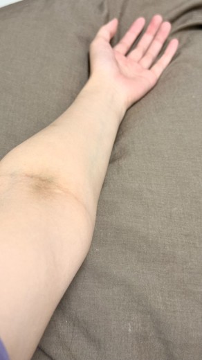 after photo: 白玉注射・点滴