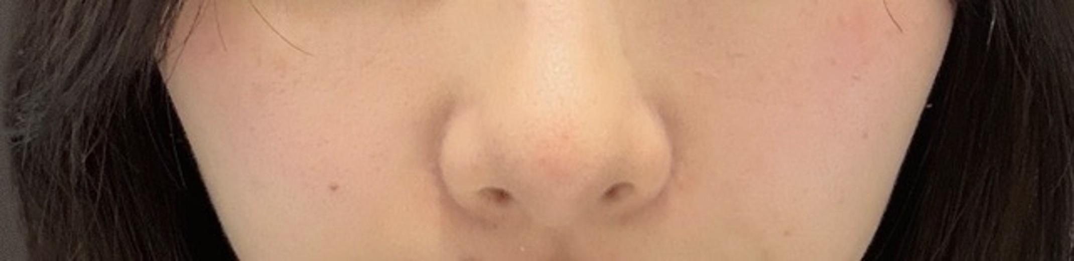 after photo: 脂肪溶解注射(顔)