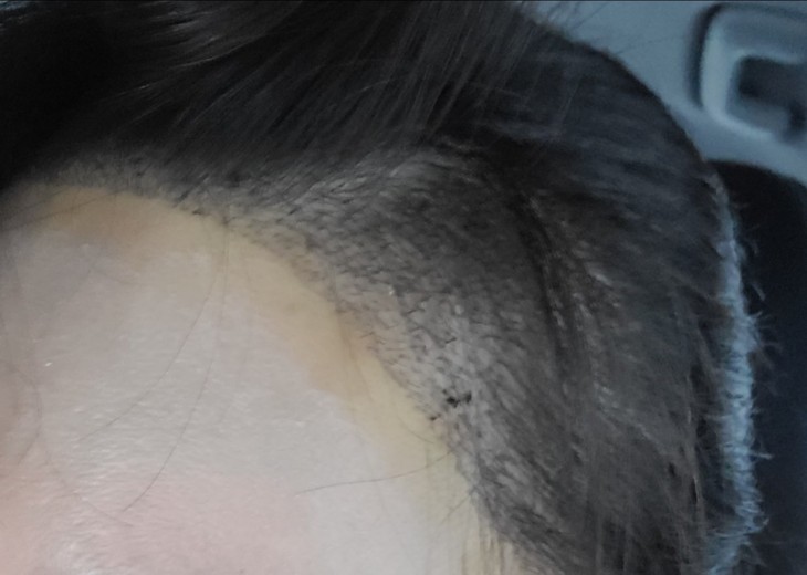 after photo: 머리모발이식