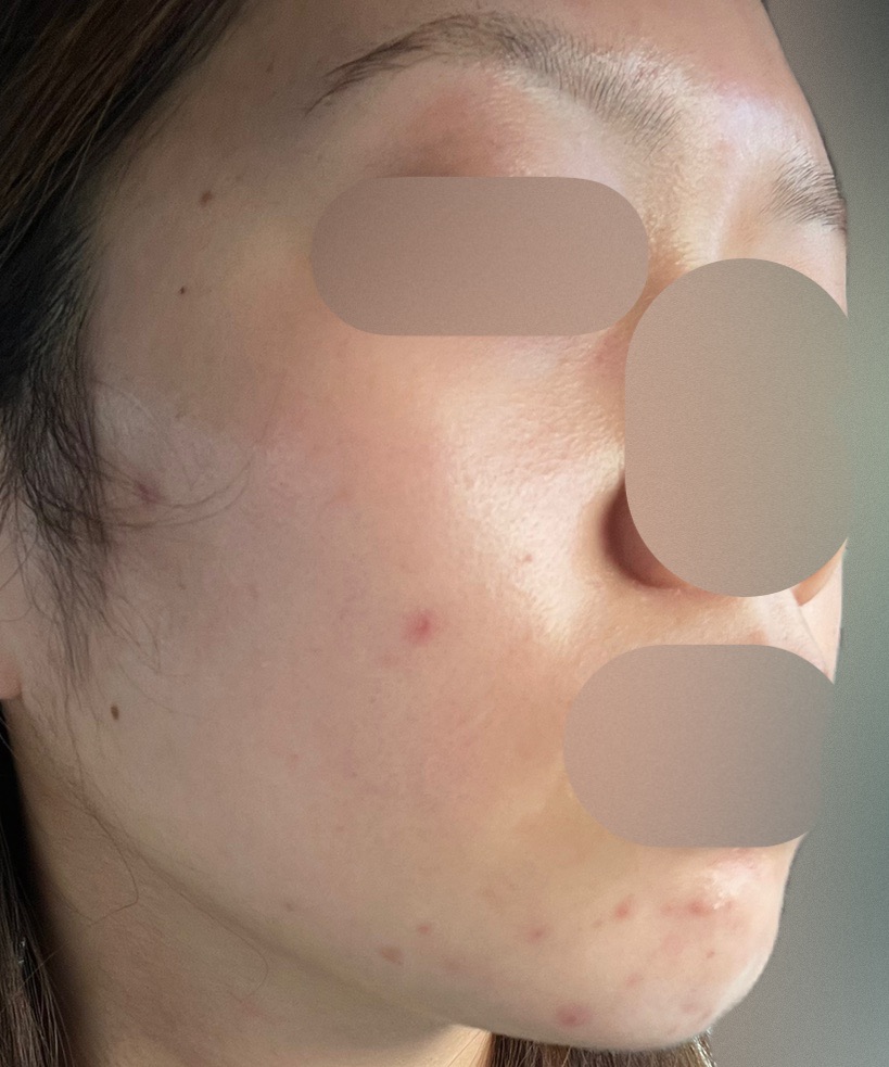 サリチル酸ピーリング | Karis Beauty Clinic