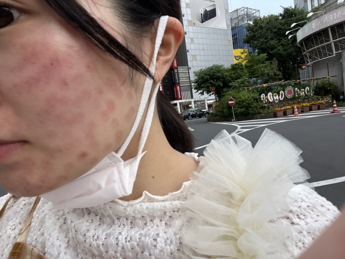 after photo: エレクトロポレーション