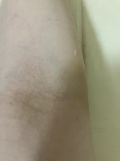 after photo: ビタミン注射・点滴