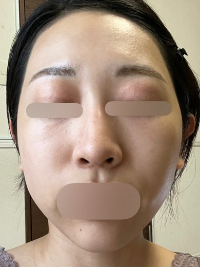 before photo: ピーリング, ハイドラジェントル