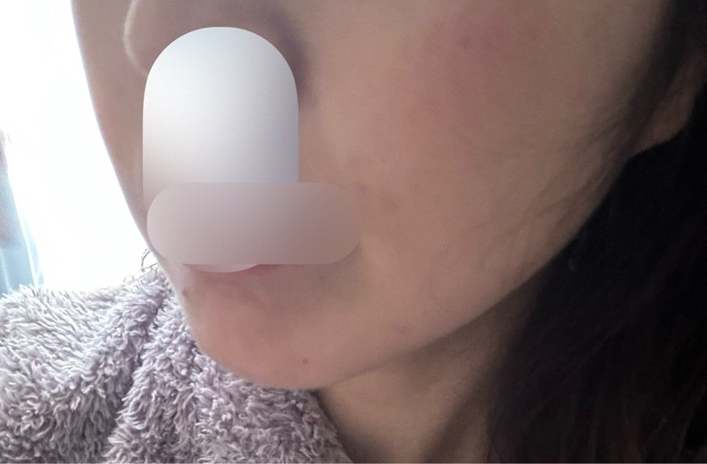 after photo: 脂肪溶解注射(顔)