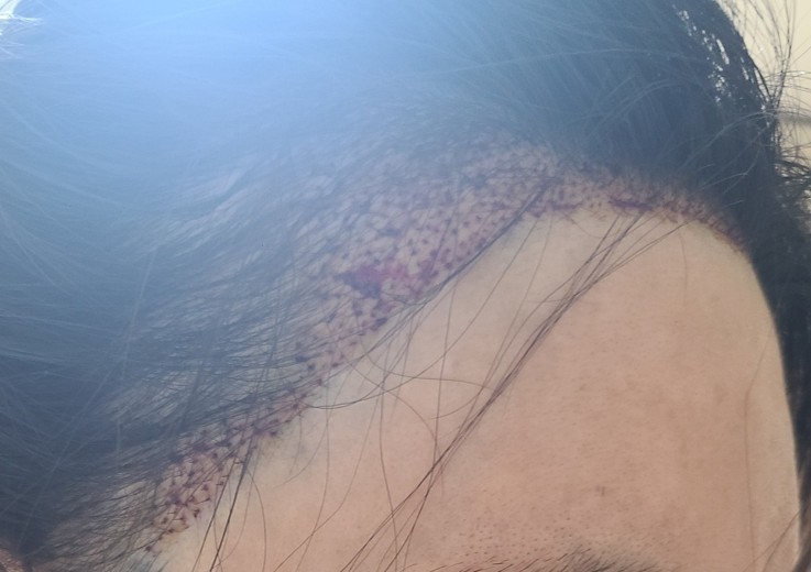 after photo: 머리모발이식