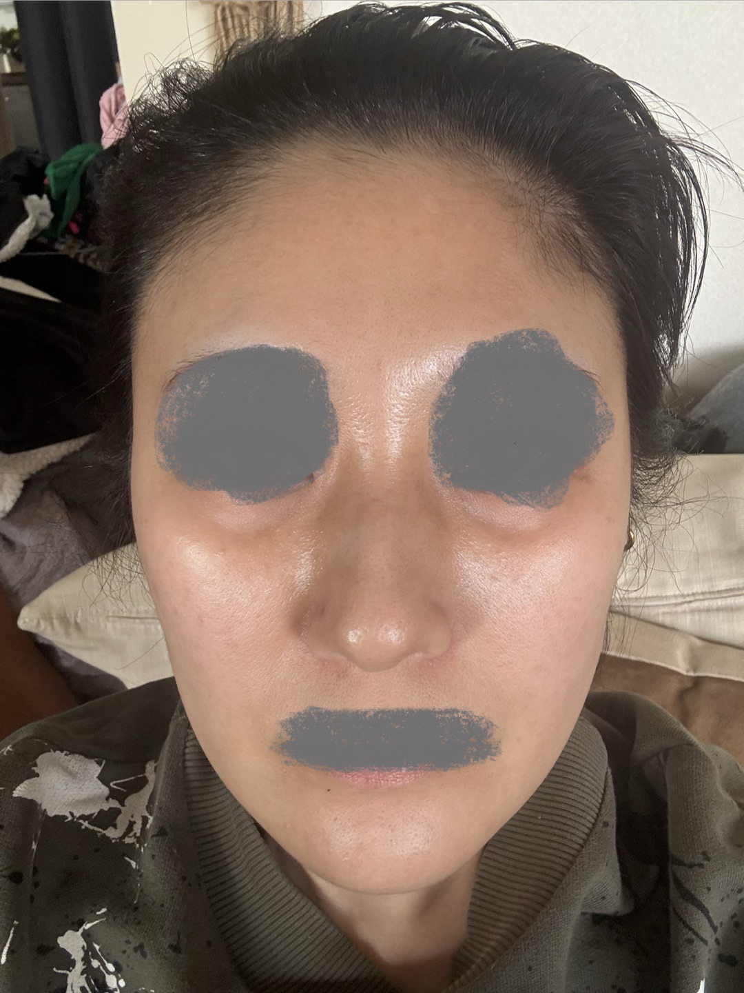 マッサージピール （顔or首＋デコルテ） | Wellness Plus Clinic